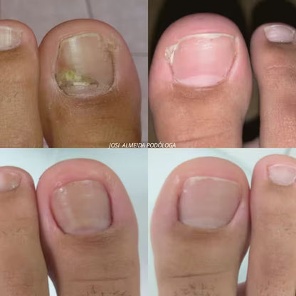 Laser UVC anti-champignons: mains et pieds