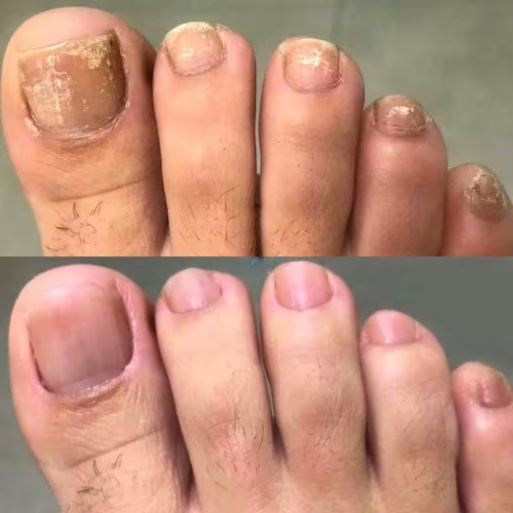 Laser UVC anti-champignons: mains et pieds