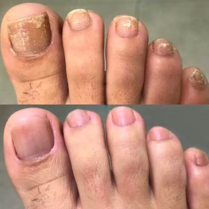 Laser UVC anti-champignons: mains et pieds