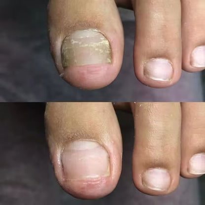 Laser UVC anti-champignons: mains et pieds