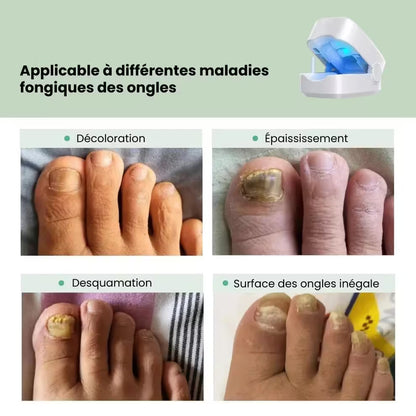 Laser UVC anti-champignons: mains et pieds
