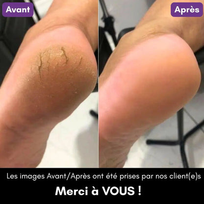 Râpe Moderne Anti - Callosités + 2 Cadeaux - Welii