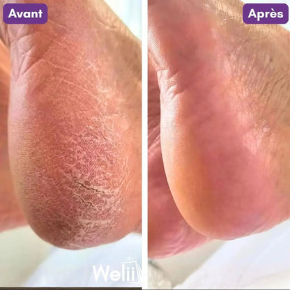 Râpe Moderne Anti - Callosités + 2 Cadeaux - Welii