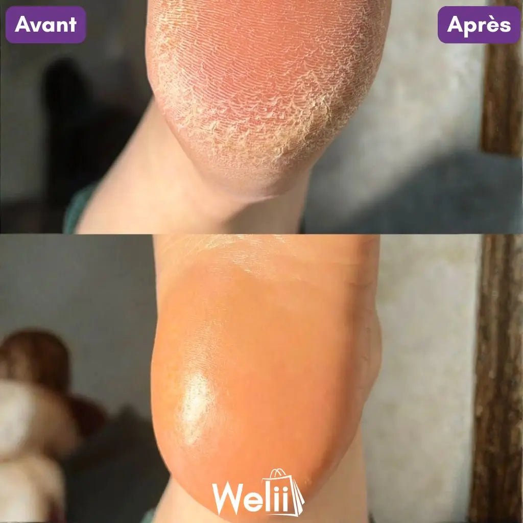 Râpe Moderne Anti - Callosités + 2 Cadeaux - Welii