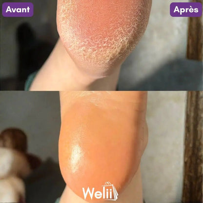 Râpe Moderne Anti - Callosités + 2 Cadeaux - Welii
