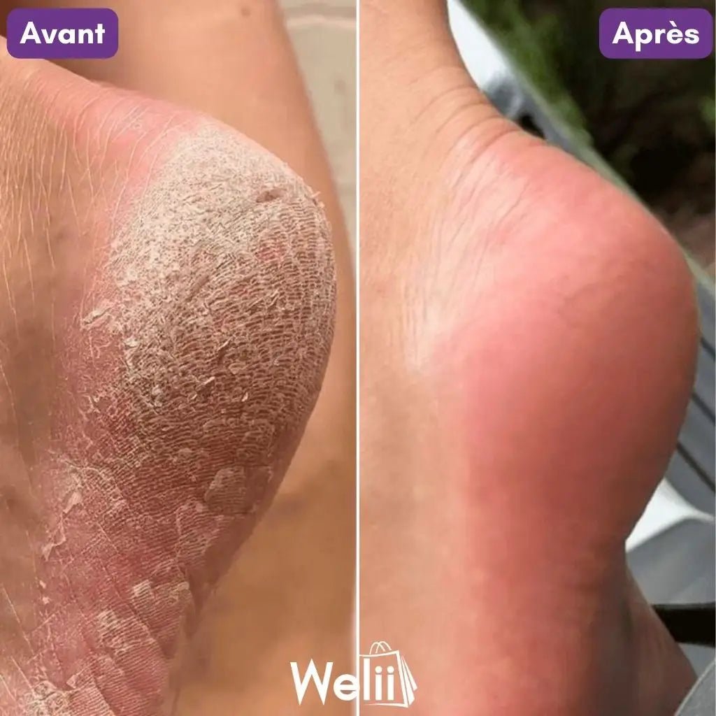 Râpe Moderne Anti - Callosités + 2 Cadeaux - Welii