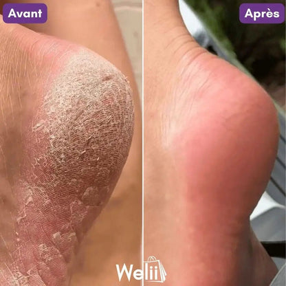 Râpe Moderne Anti - Callosités + 2 Cadeaux - Welii